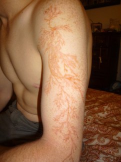 Lightning scar